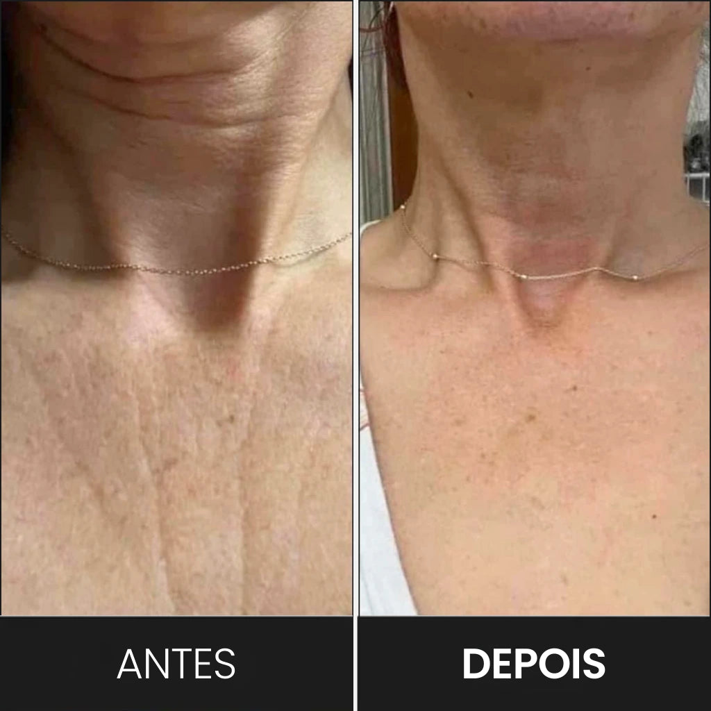 Tecnologia de Rejuvenescimento Facial para Reduzir Papada e Recuperar a Firmeza.