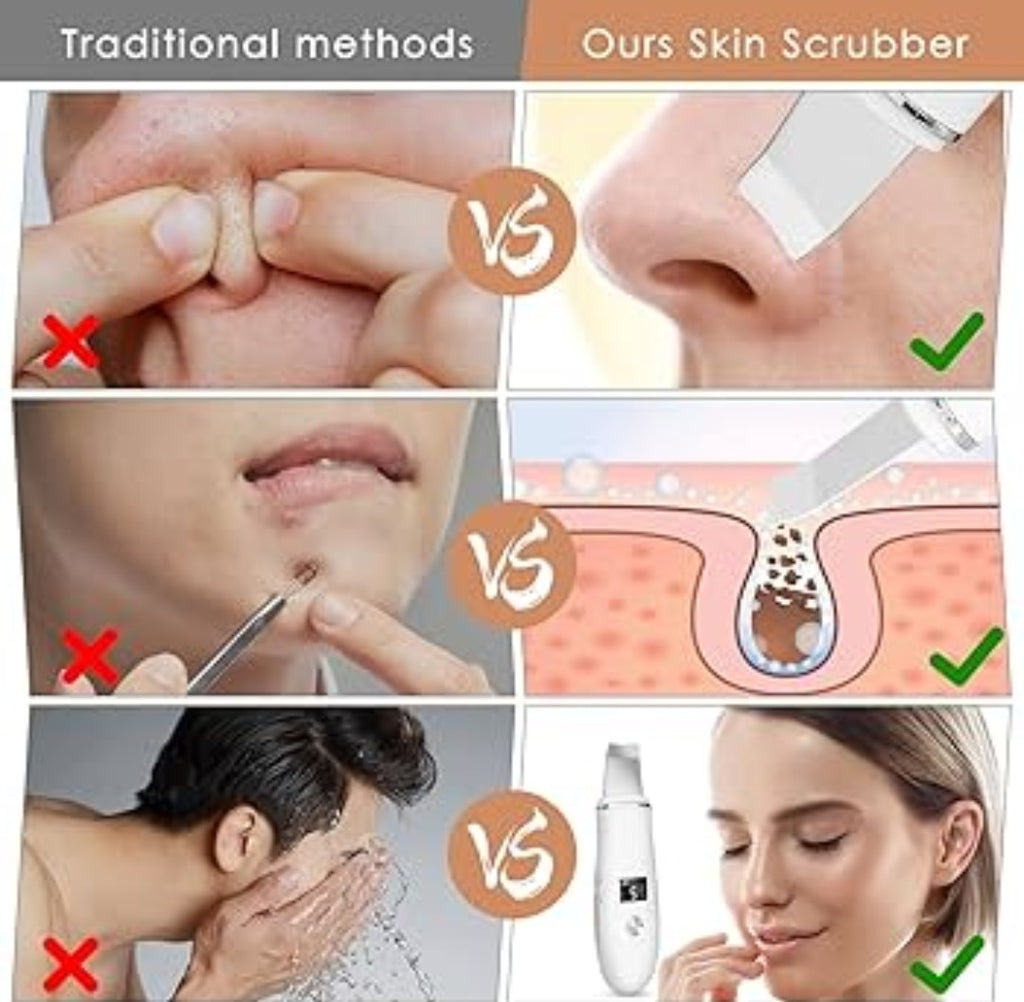 Peeling Ultrassônico Facial – Limpador de Cravos e Rejuvenescedor Portátil